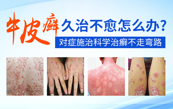 牛皮癣会带来哪些并发症